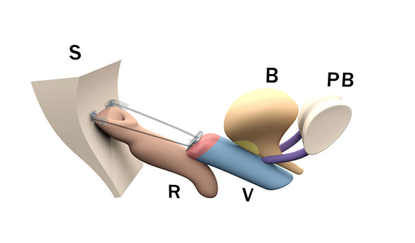 position cesa vasa in small pelvis